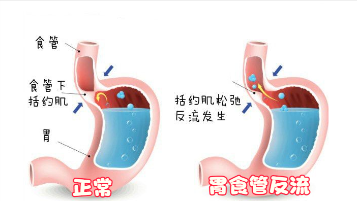 胃食管反流的“杀伤力”真不小，远离这几种食物，胃会感激你(图4)