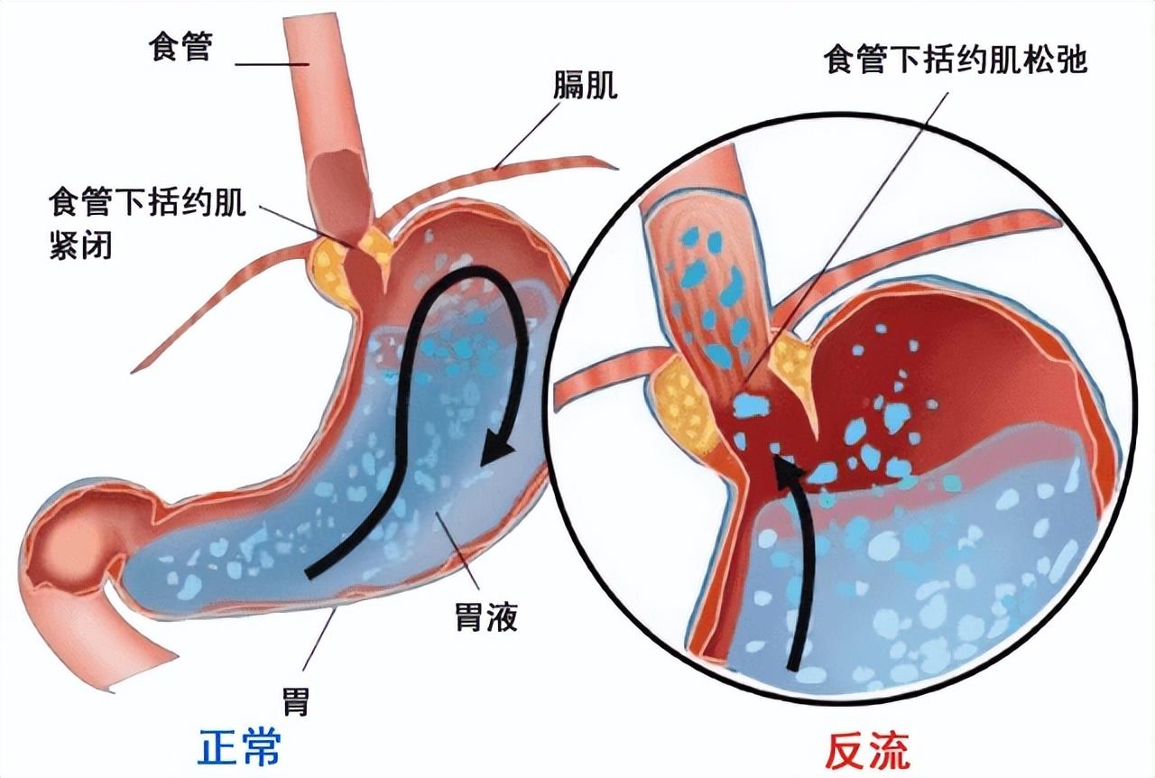 胃食管反流的“杀伤力”真不小，远离这几种食物，胃会感激你(图10)