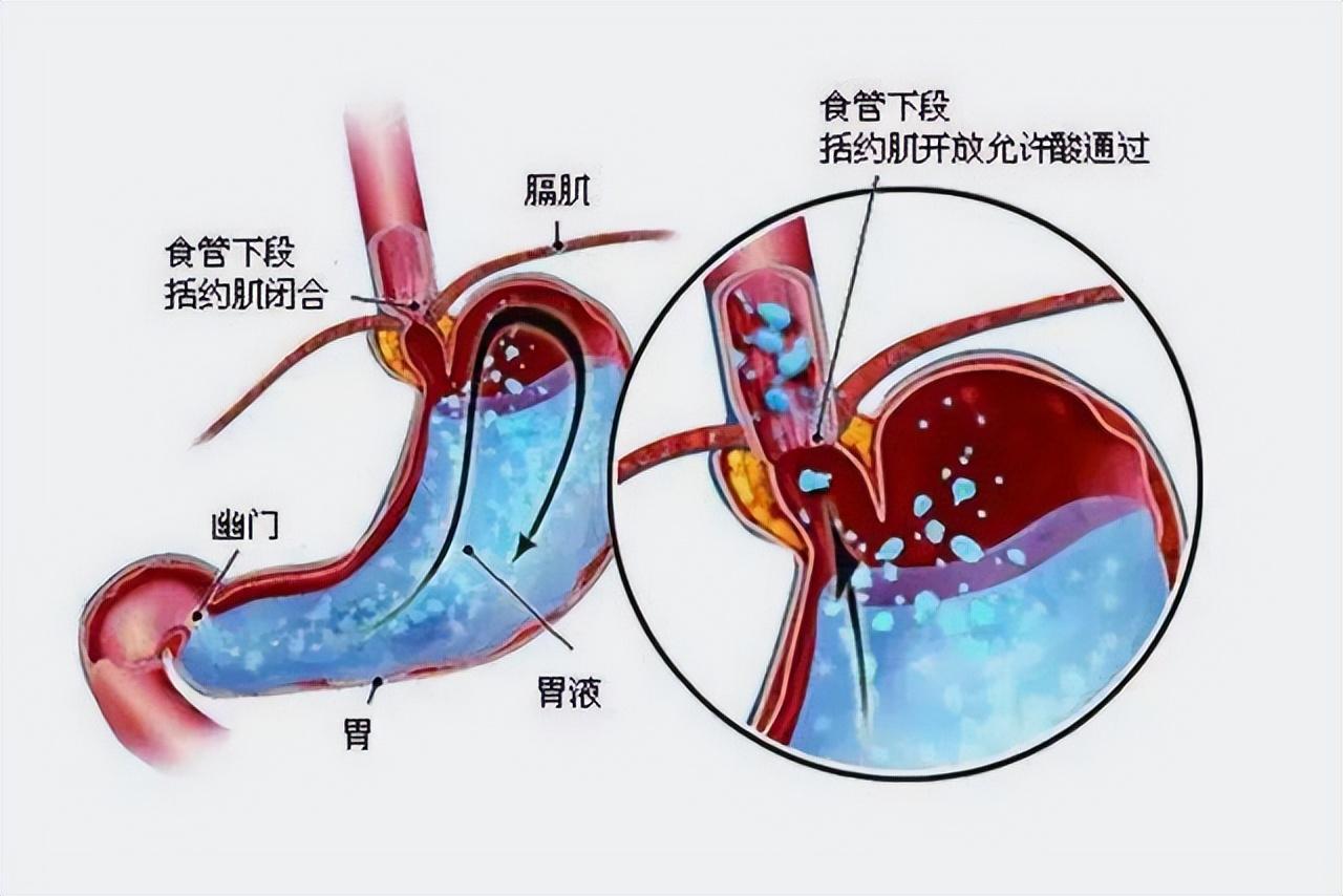 胃食管反流的“杀伤力”真不小，远离这几种食物，胃会感激你(图8)