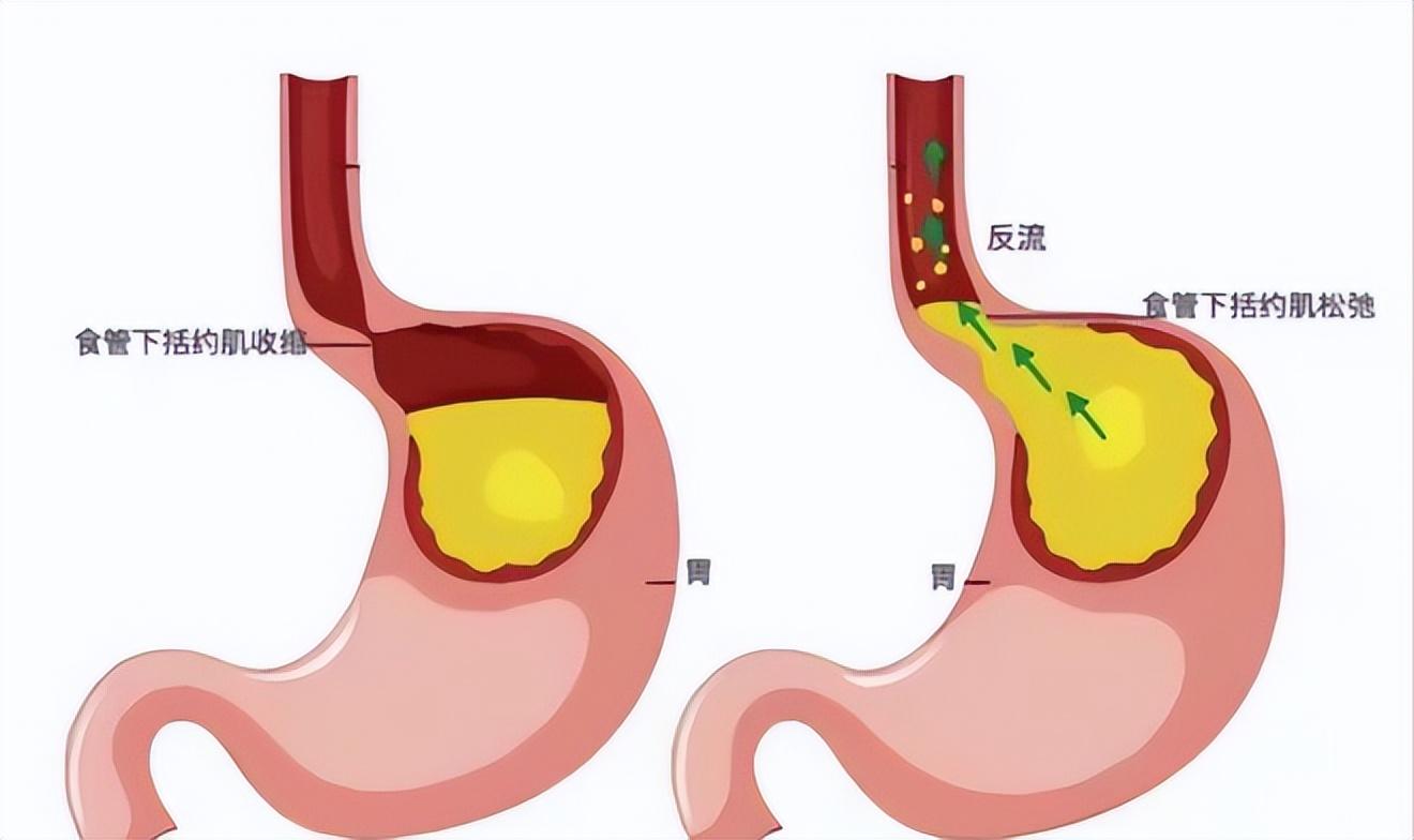 胃食管反流的“杀伤力”真不小，远离这几种食物，胃会感激你(图9)